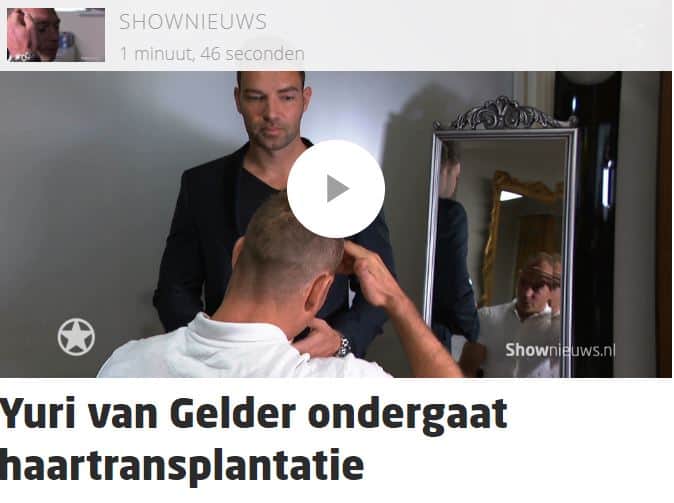 Haartransplantatie Yuri van Gelder bij Acura Medisch Centrum.